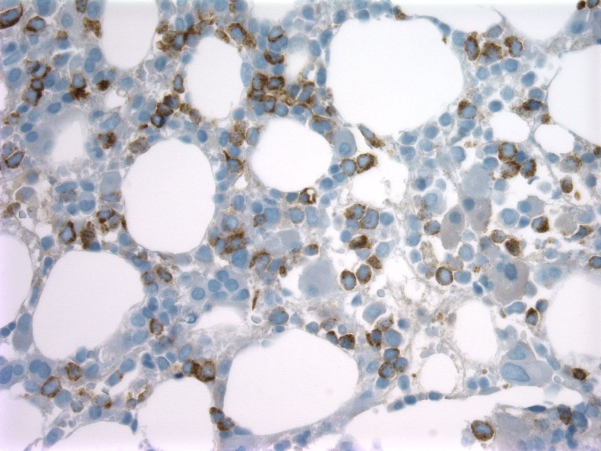 CD34, bone marrow biopsy